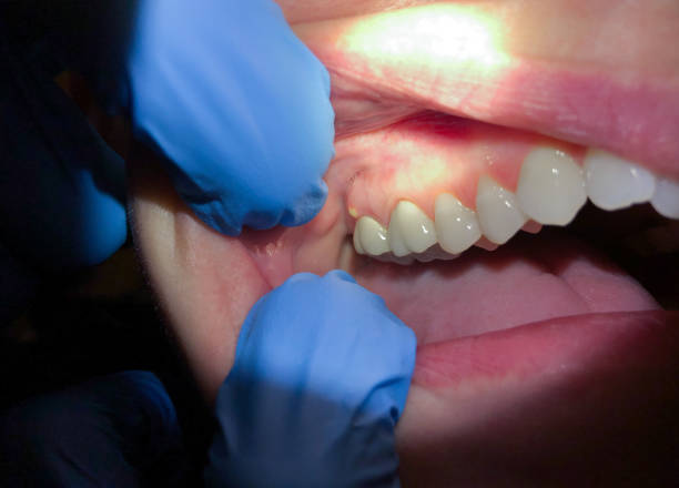 Best Emergency Treatment for Dental Infections or Abscesses in Fillmore, UT