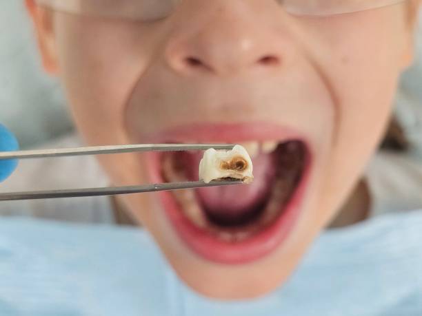 Best Urgent Care for Lost Fillings or Crowns in Fillmore, UT